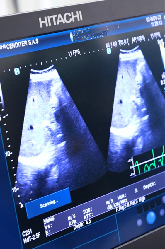 Ecografía endoscópica biliopancreatica