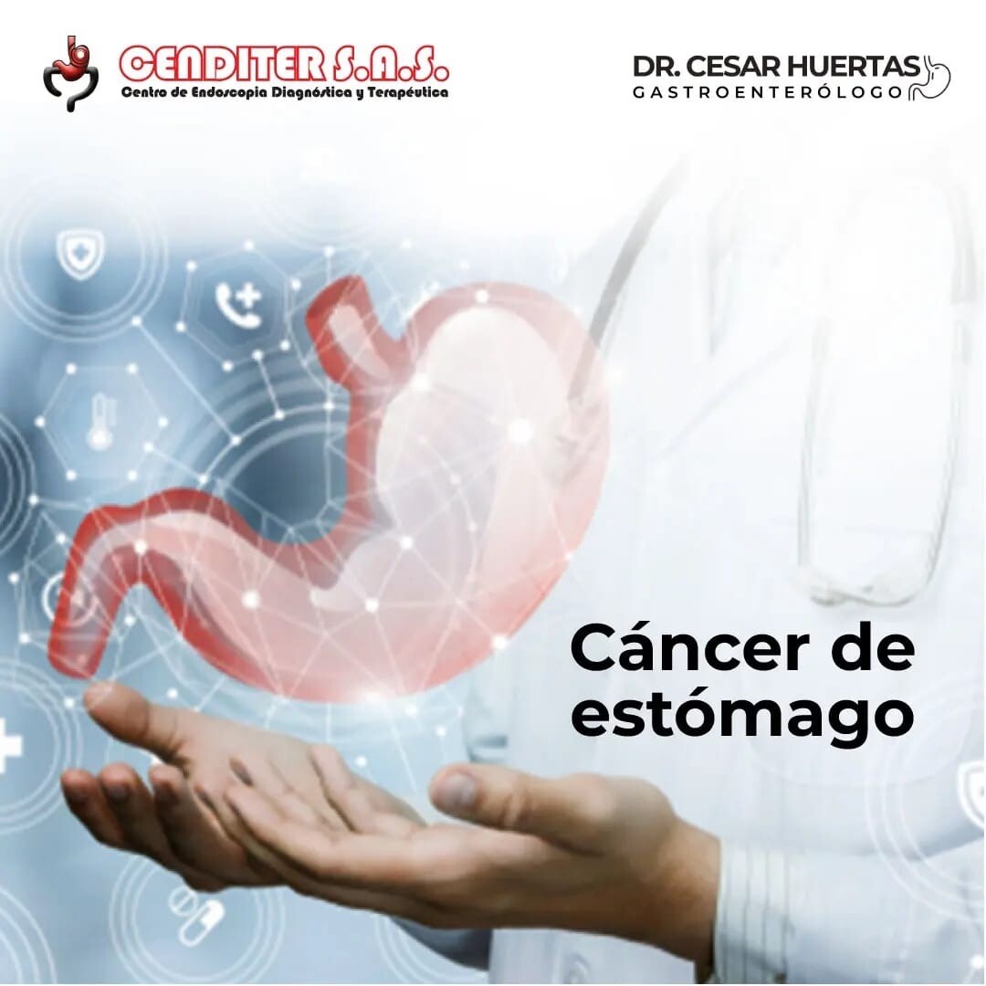 ¿Que es el Cáncer de Estómago?
